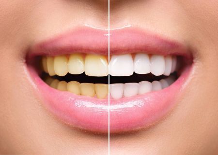 مأكولات تسبب اصفرار أسنانك وتضعفها لا تفرطي في تناولها