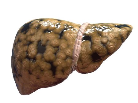 الكبد الدهني  أحدث الامراض المنتشرة التي تقتل الملايين